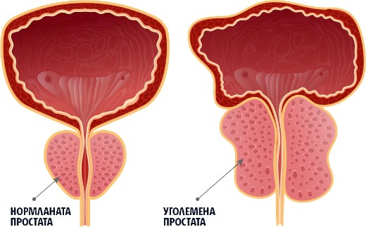 Уголемена простата